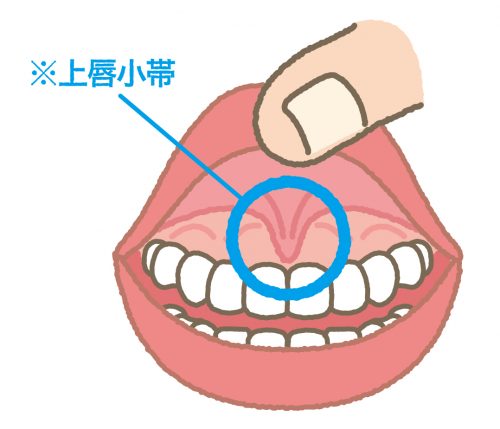 Clip art of upper lip band